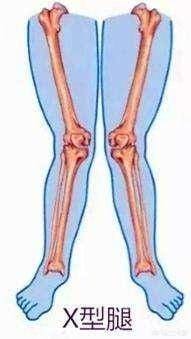 X-leg Shapes in Women