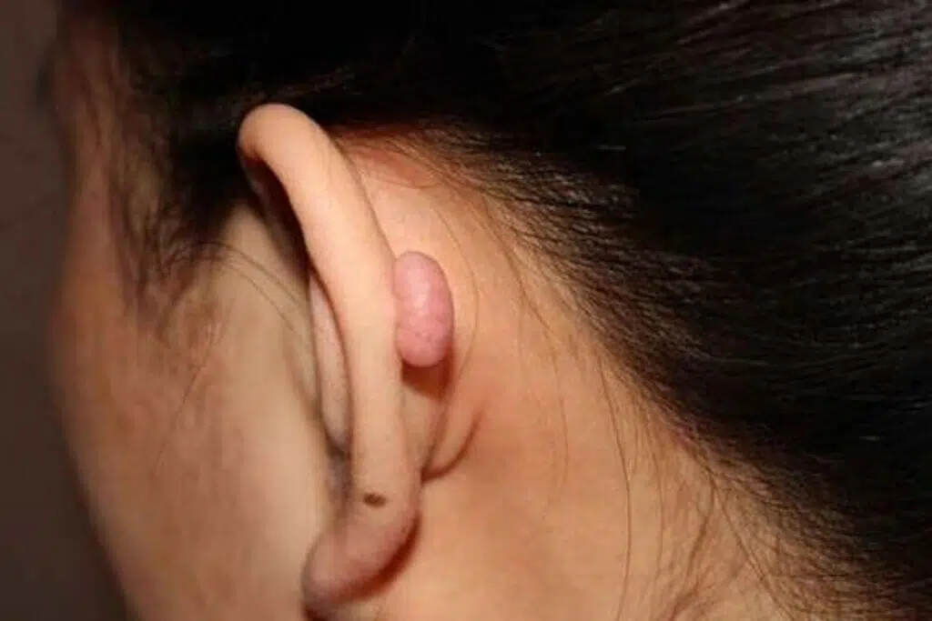 side effects of helix piercing